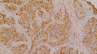 CAPER-strained, triple-negative breast cancer tissues