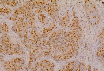 CAPER-strained, triple-negative breast cancer tissues